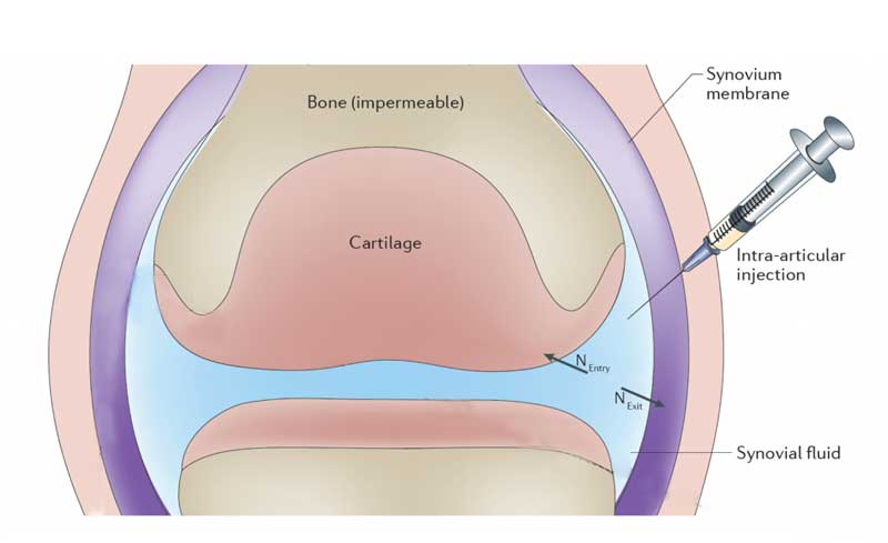 infiltrazioni intra-articolari